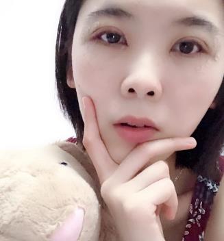 华西医院双眼皮介绍展示，看卿勇医生技术实力如何？