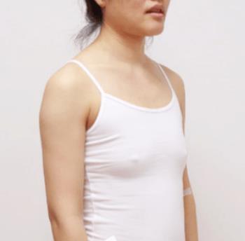 北京圣嘉新邱立东自体脂肪隆胸介绍分享！不看你就后悔！