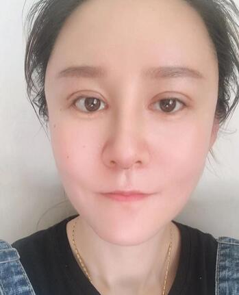 上海华美割双眼皮介绍分享，附恢复过程记录