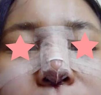 上海九院戴传昌鼻部手术介绍反馈：术后两个月果真不赖！
