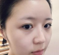 北京伊芙丽格切开双眼皮术后两个月果图分享，附医生推荐
