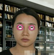 北京空军总医院激光美容科隆鼻怎么样?案例术后果实拍分享