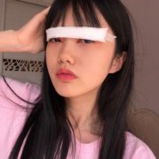 深圳米兰柏羽整形医院做双眼皮案例分享!看术前术后素颜对比