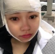 2022江西省人民医院整形颌面外科价格价目表_改脸型案例前后变化分享