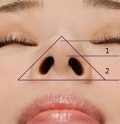 鼻小柱整形有哪些方法?鼻小柱整形有哪些优势？