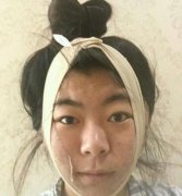 深圳北大医院整形科吸脂瘦脸案例恢复过程、收费价格一一揭晓