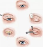 双眼皮整形的方法有哪些?双眼皮整形后多久恢复?