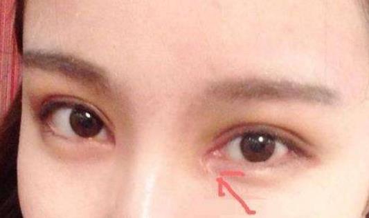 开内眼角有什么副作用，会留下疤痕吗？