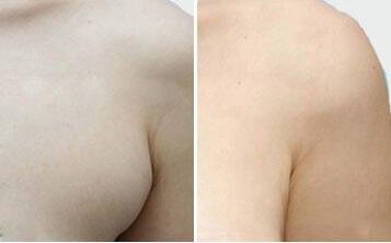 副乳切除术后的护理要点，多久可以抬手臂?
