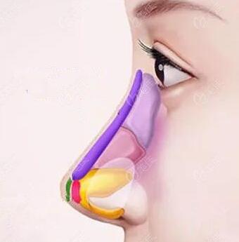鼻子再造的危害有哪些?做完之后应该怎么护理?
