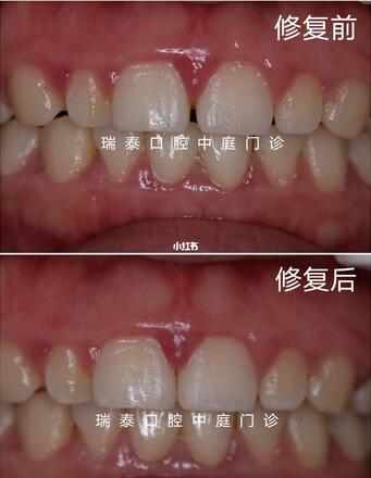 前牙树脂美学修复的过程是怎样的?