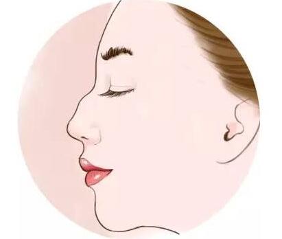 驼峰鼻矫正技术是怎样的?有哪些风险和注意事项?