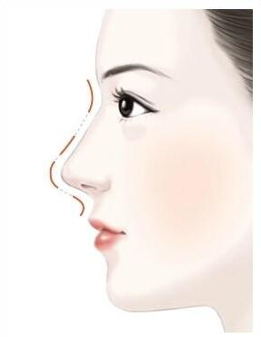 鼻尖整形是什么?鼻尖整形有哪些方法?