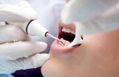 超声波洗牙能美白牙齿吗，可以去除黄牙吗?