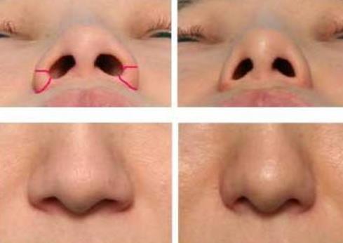 如何防止鼻翼缩小的疤痕？
