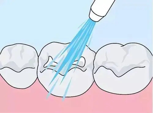 洗牙能不能美白牙齿?有哪些预防牙齿松动的方法？