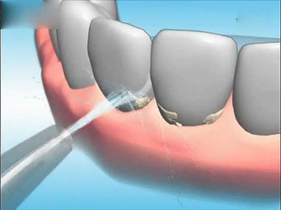 如何保持牙齿洁白?洗牙后牙齿缝隙变大是怎么回事？