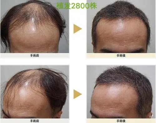 种植头发能保持几年？植发多久能看到效果？