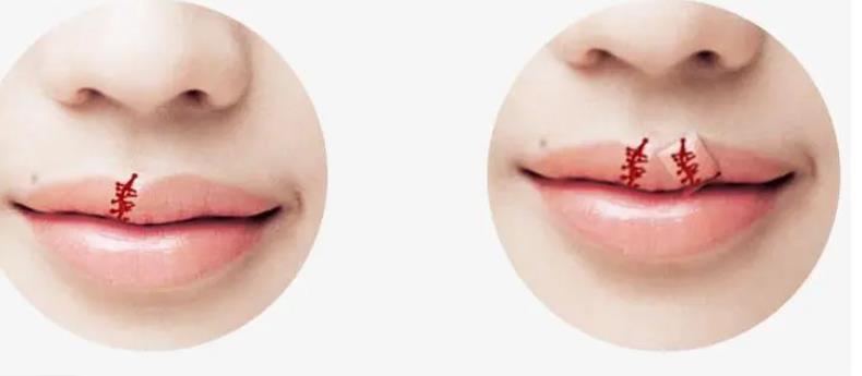 唇裂术后畸形的原因是什么?
