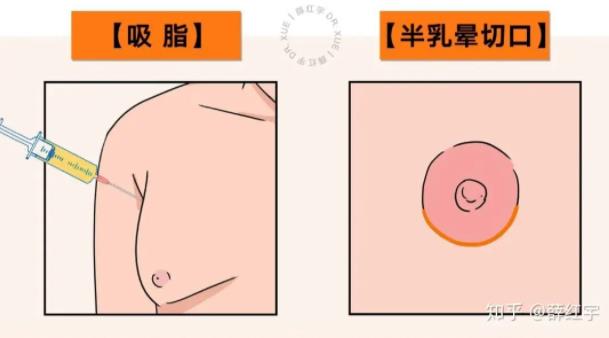 乳房缩小手术是怎么做的？手术的详细步骤