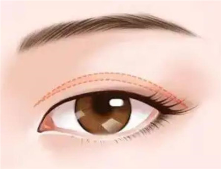 完成双眼皮手术后的注意事项有哪些?