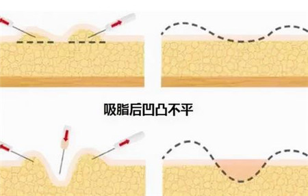 水动力吸脂会留疤吗，水动力吸脂有什么优点