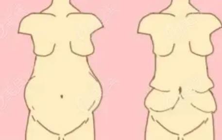腹壁整形有哪些手术方法