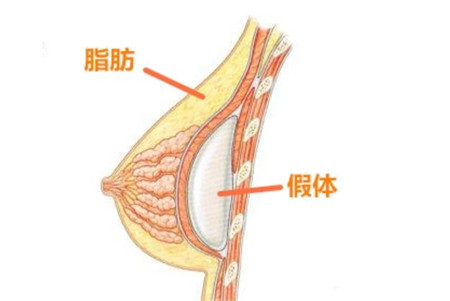 假体隆胸有哪些优点?哪些人群适合假体隆胸