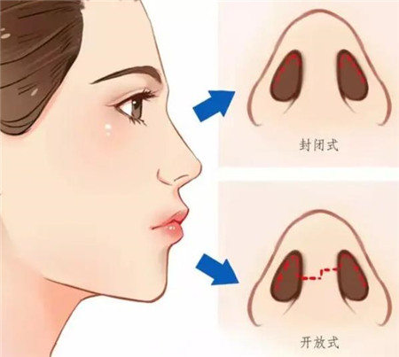 耳软骨隆鼻尖能保持多久