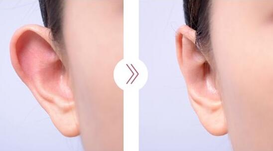 招风耳整形手术步骤有哪些?招风耳整形手术在要多少钱?
