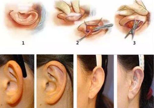 招风耳经常有什么临床症状?招风耳修正的价格多少?