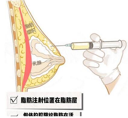 自体脂肪隆胸有硬块怎么办?自体脂肪隆胸有硬块需要二次手术吗?