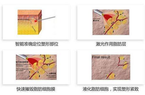 激光溶脂果好吗_怎么样【果图】