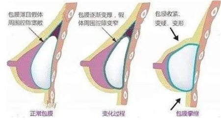 假体隆胸术后护理会影响手感吗?