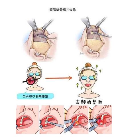 去颊脂垫恢复期是多久?过程需要注意哪些?