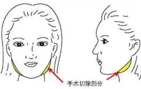 颧骨颧弓切除术的适应症有哪些?