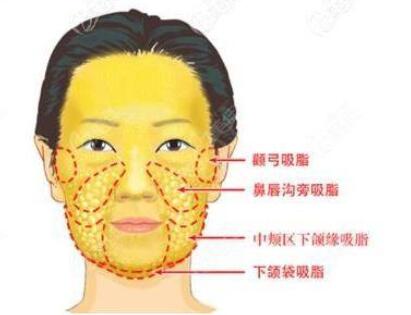 面部抽脂后消肿时间和恢复期是多久？