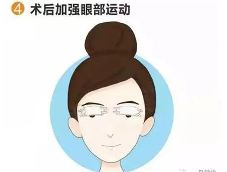 双眼皮手术有哪些缺点以及怎么护理