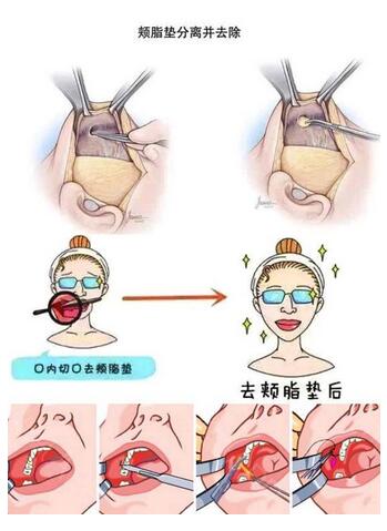去颊脂垫果怎么样?吗?