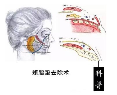 去颊脂垫有副作用吗?术后如何护理可以减小副作用?