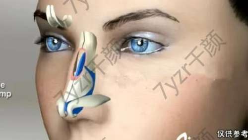 驼峰鼻矫正的恢复时间受哪些因素的影响？