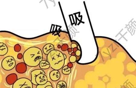 腰部吸脂是从后面吸的吗?