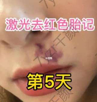 什么因素决定激光去除胎记后的恢复时间？