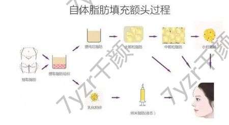 自体脂肪填充有副作用吗，充什么时候做合适