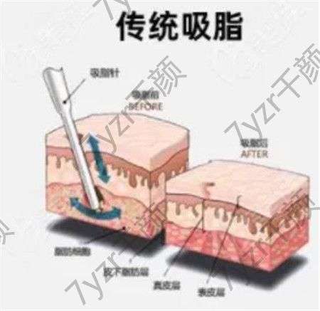 影响水动力吸脂价格的因素有哪些?