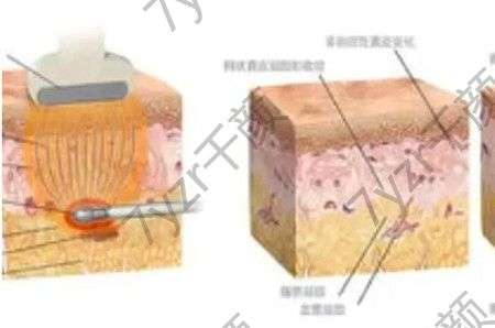 水动力吸脂能吸面部吗，吗