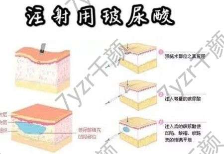 玻尿酸注射后的注意事项有哪些