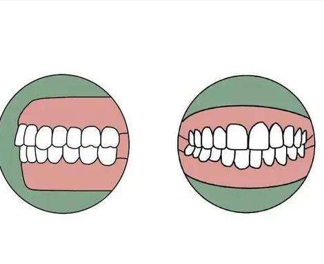 成人牙齿反颌怎么矫正？分享常见的矫正方法