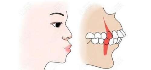 龅牙好矫正吗？了解龅牙矫正的效果和方法！