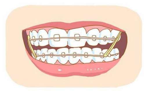 龅牙30岁还能矫正牙齿吗?专家解答及年人牙齿矫正技术介